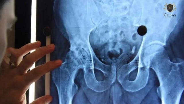 Homem garante realizao de cirurgia de quadril via SUS no prazo de seis meses