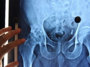 Homem garante realizao de cirurgia de quadril via SUS no prazo de seis meses